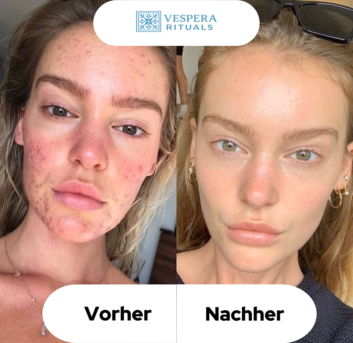 Vespera Clear & Lift™ + GRATIS Hautpflege-Geheimnisse E-Book