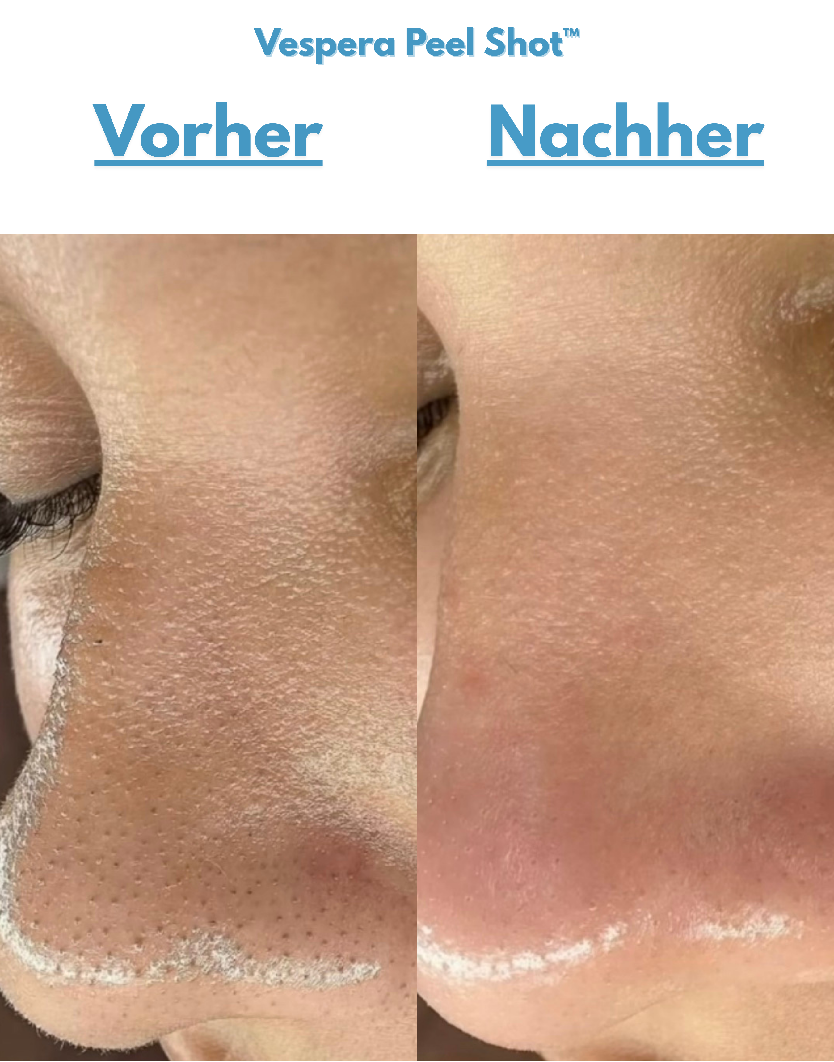 Vespera Peel Shot™